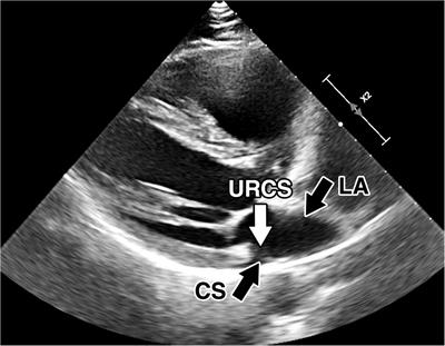 Case report: Robotic repair of unroofed coronary sinus